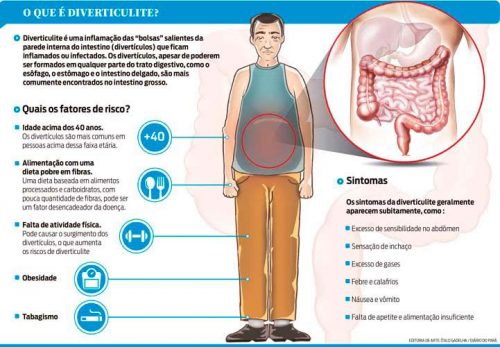 Diverticulite é Preciso Ter Muito Cuidado Diersmann 3905